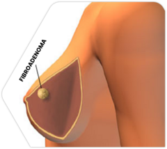 <p>MC in late teen/early 20's</p><p>Benign solid tumors containing glandular/fibrous tissues</p>