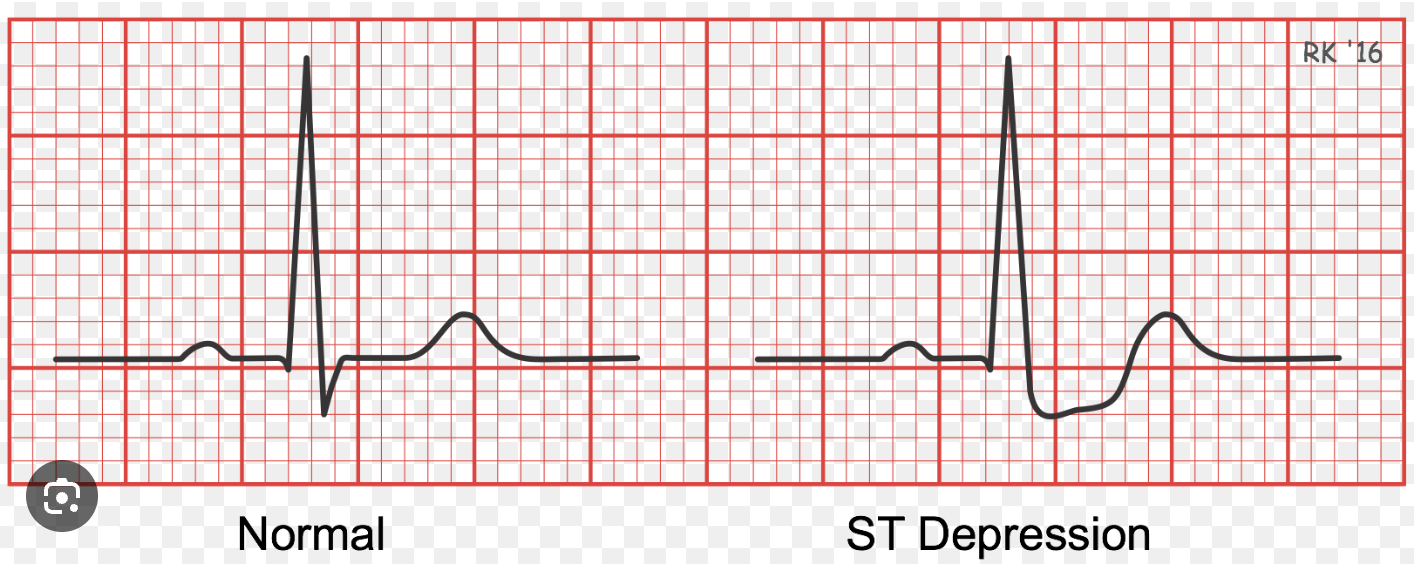 <p><strong>Ischemia</strong>: Shows T wave inversion and ST depression </p>