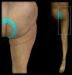 <p>D: Groin, medial thigh to knee</p><p>M:</p>