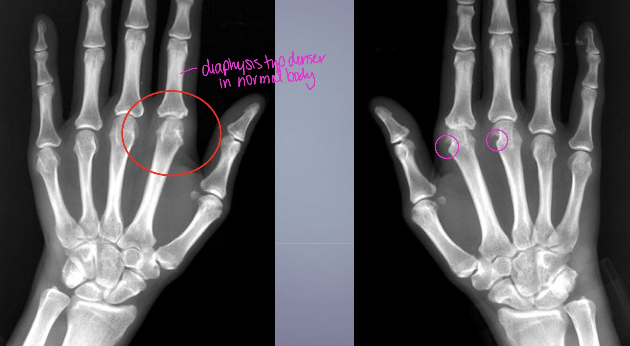 <p>What two findings of RA are found in this image</p>