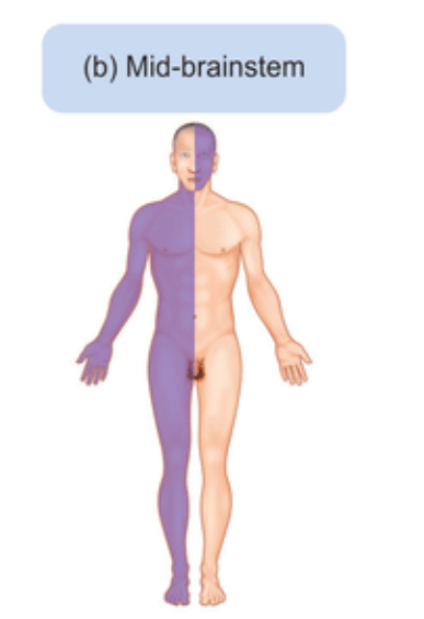 <p>Results in ipsilateral sensory loss in the head, then contralateral sensory loss in the rest of the body.</p>