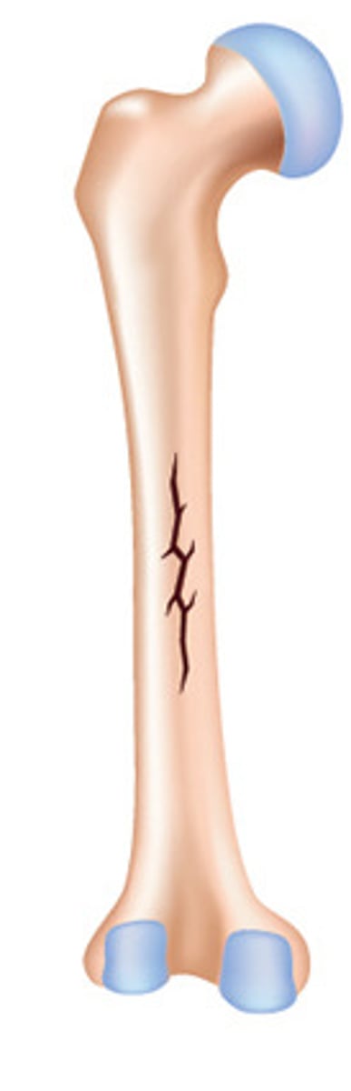 <p>a bone fracture that runs longitudinally or up and down</p>