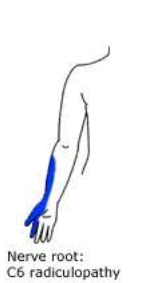 <p><span>Occurs due to nerve root damage (e.g. compression by a herniated intervertebral disc), resulting in sensory disturbances in the associated dermatomes.</span></p>