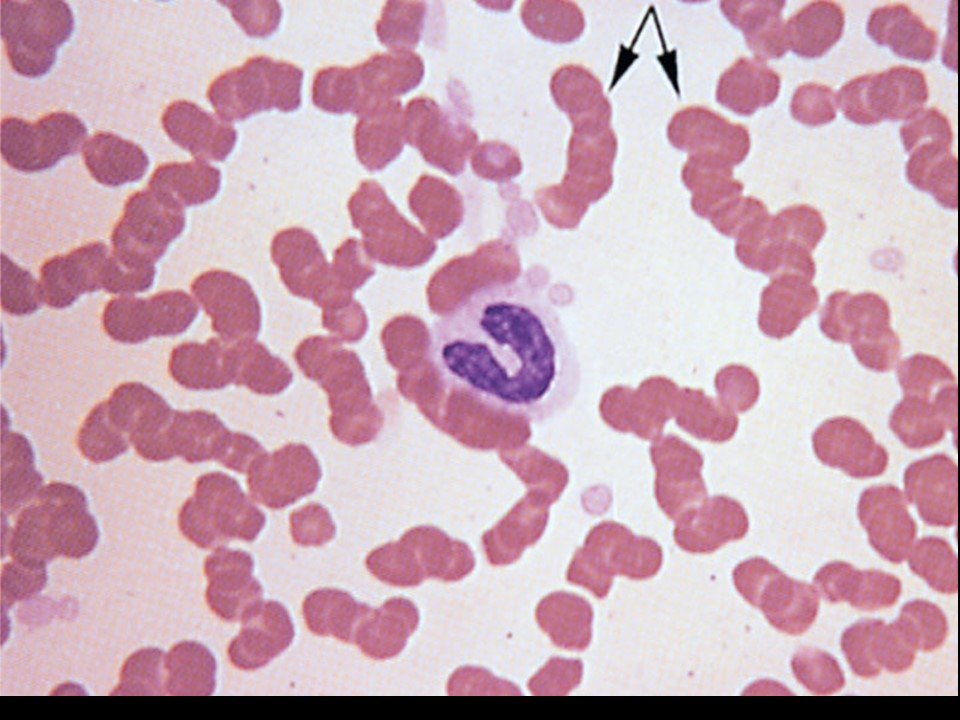 <p><span>The red blood cells below are exhibiting</span></p>