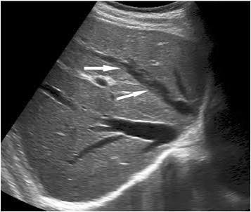 <ul><li><p>enlarged caudate</p></li><li><p>rt lobe atrophy</p></li><li><p>low vis of HVs</p></li><li><p>clot in HV or IVC </p><ul><li><p>no flow in HVs</p></li></ul></li><li><p>ascites</p></li></ul><p></p>