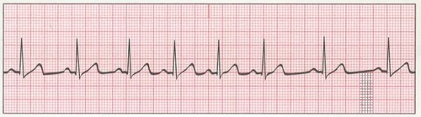 <p>A disturbance in the heart rate and rhythm</p>