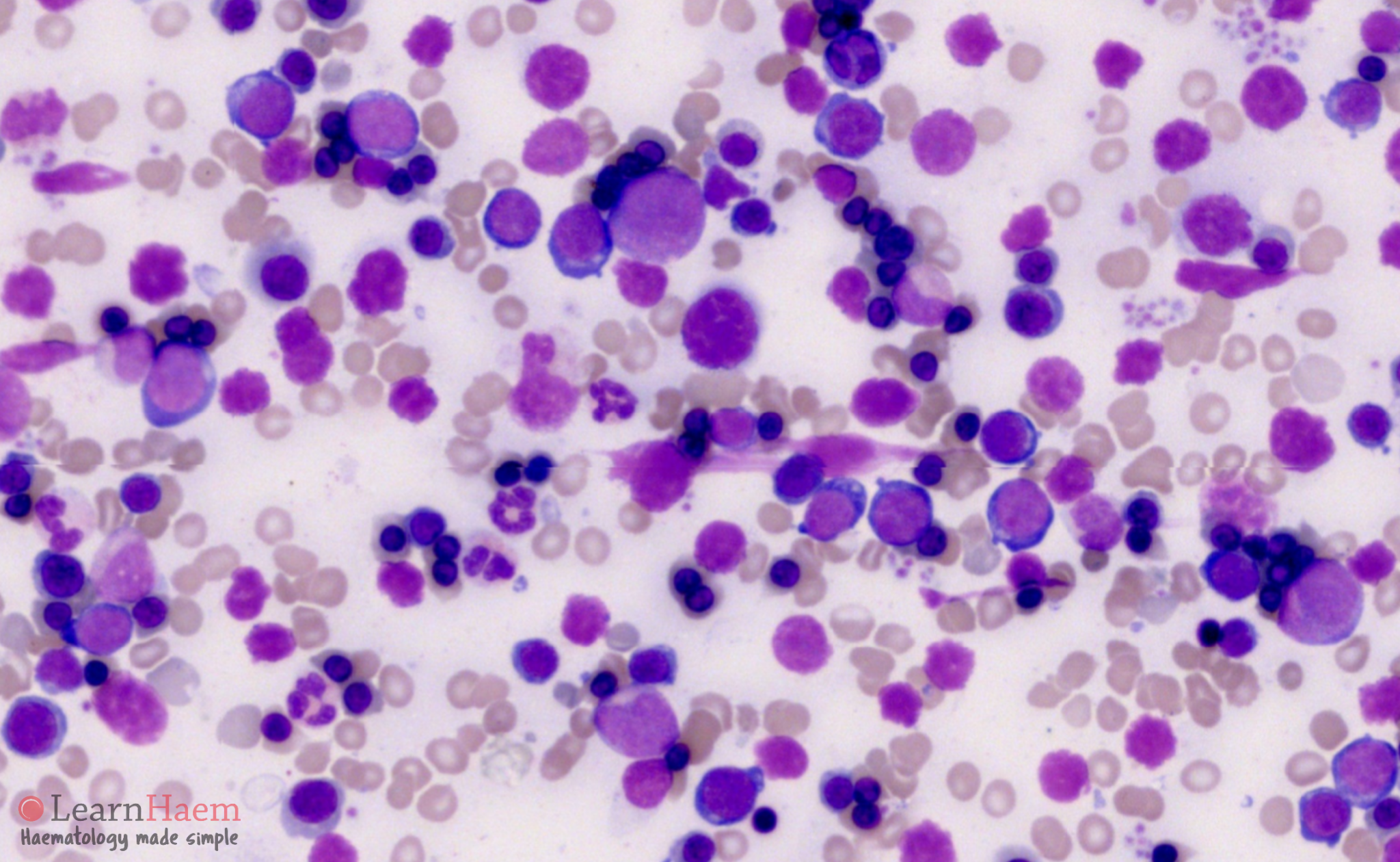 <p>irregular shaped blasts</p><p>irregular nucleoli</p><p>multinucleation</p><p>cytoplasmic vacuolation</p><p>lots of erythroblasts</p>