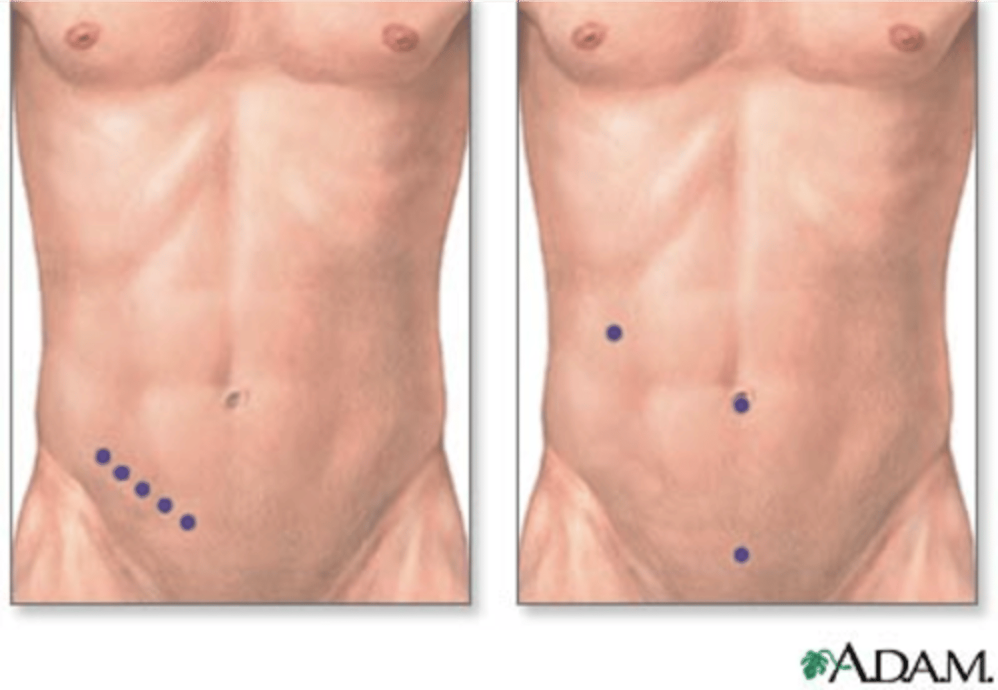 <p>appendectomy</p>