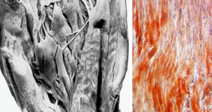 <ul><li><p>ląstelė padidėjusi</p></li><li><p>citoplazmoje baltai geltoni ląšeliai</p></li><li><p>išsaugo savo konfiguraciją</p></li><li><p>gali ląstelė atsistatyti</p></li></ul><p></p>