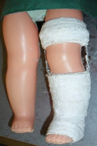 <p><span>fracture of the distal third of femur with callus formation</span></p>