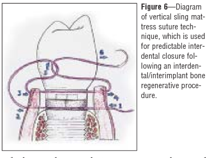 <ul><li><p>especially useful in periodontal flap surgeries</p></li><li><p>wraps around a tooth to stabilised a flap on one side</p></li><li><p>Two types:</p></li></ul><ol><li><p>single sling = around one tooth</p></li><li><p>double sling = around two adjacent teeth</p></li></ol><p></p>