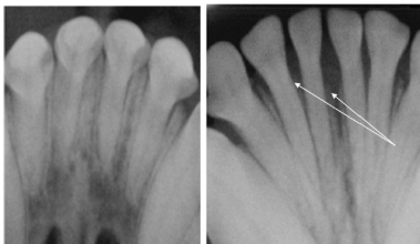 <p>Compare the right radiograph to the left</p>