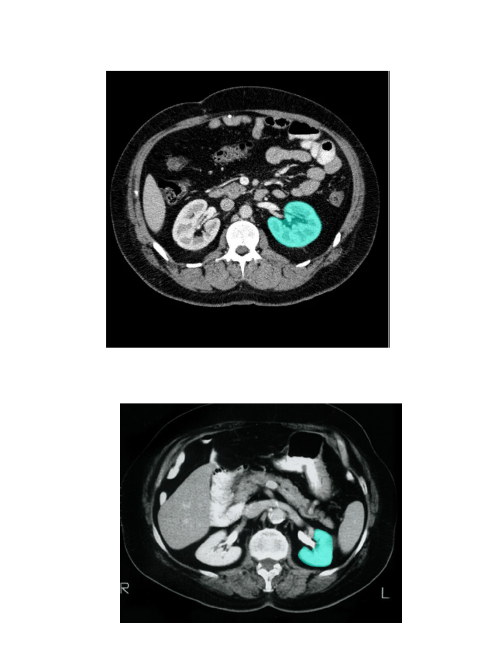 <p><span>Left kidney</span></p>