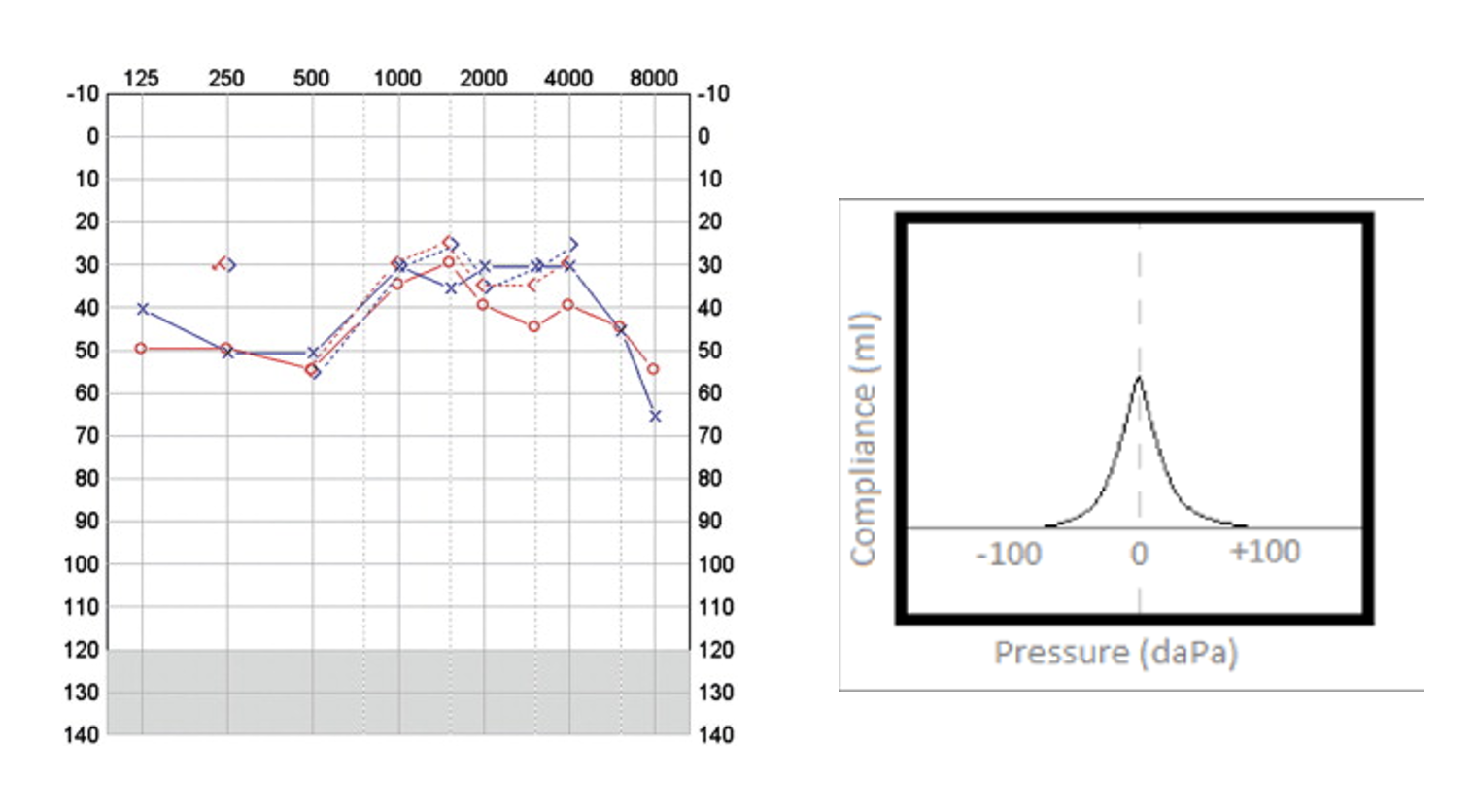 <p><span>Woke up with no hearing in the left ear</span></p><p><span>Tinnitus</span></p><p style="text-align: left;"><span>Aural fullness</span></p>