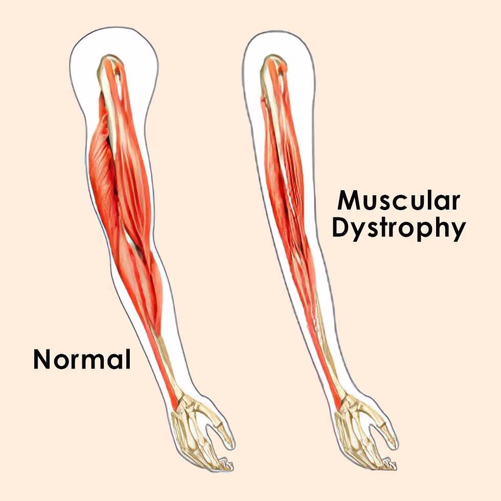 <p><span><strong>Muscular dystrophy</strong></span></p>