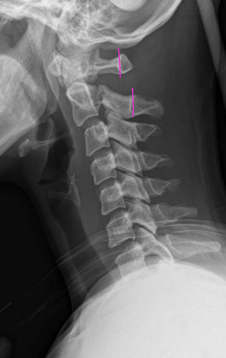 <p>What are three things that could cause anterior displacement of C1</p>