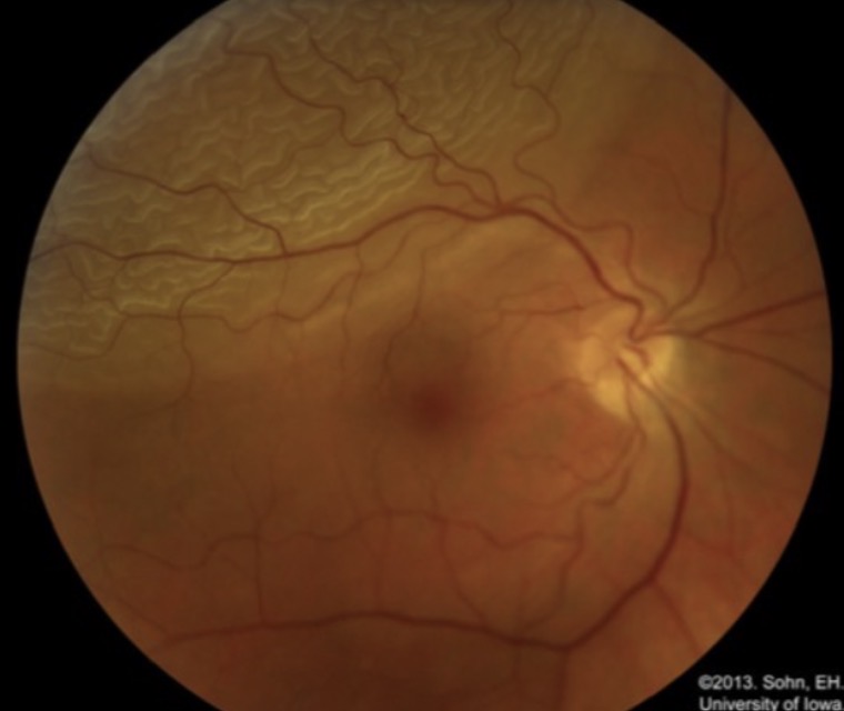 <p><span>Une femme de 53 ans, myope de -7.00 dioptries, se présente pour photopsie en inférieur et perte de champ visuel inférieur de l'oeil droit. À l'examen au fond d'oeil, vous voyez ce qu’il y a dans l’image. Quel est le diagnostic le plus probable ?</span></p><p></p><p><span>A. Thrombose de branche artérielle supérieure</span></p><p><span>B. ﻿﻿﻿Mélanome oculaire</span></p><p><span>C. Décollement de la rétine supérieure</span></p><p><span>D. Dégénérescence maculaire exsudative</span></p>