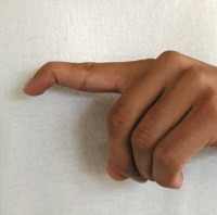 <p>Injury to distal extensor tendon causing DIP flexion contracture.</p>