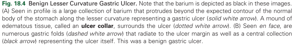 <p>Benign Lesser Curvature Gastric Ulcer.</p>