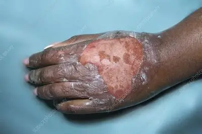 <p>Classification this burn is a</p>