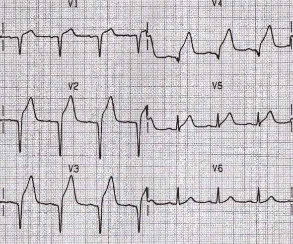 <p>What pathology is shown on the ECG? What are the defining characteristics?</p>