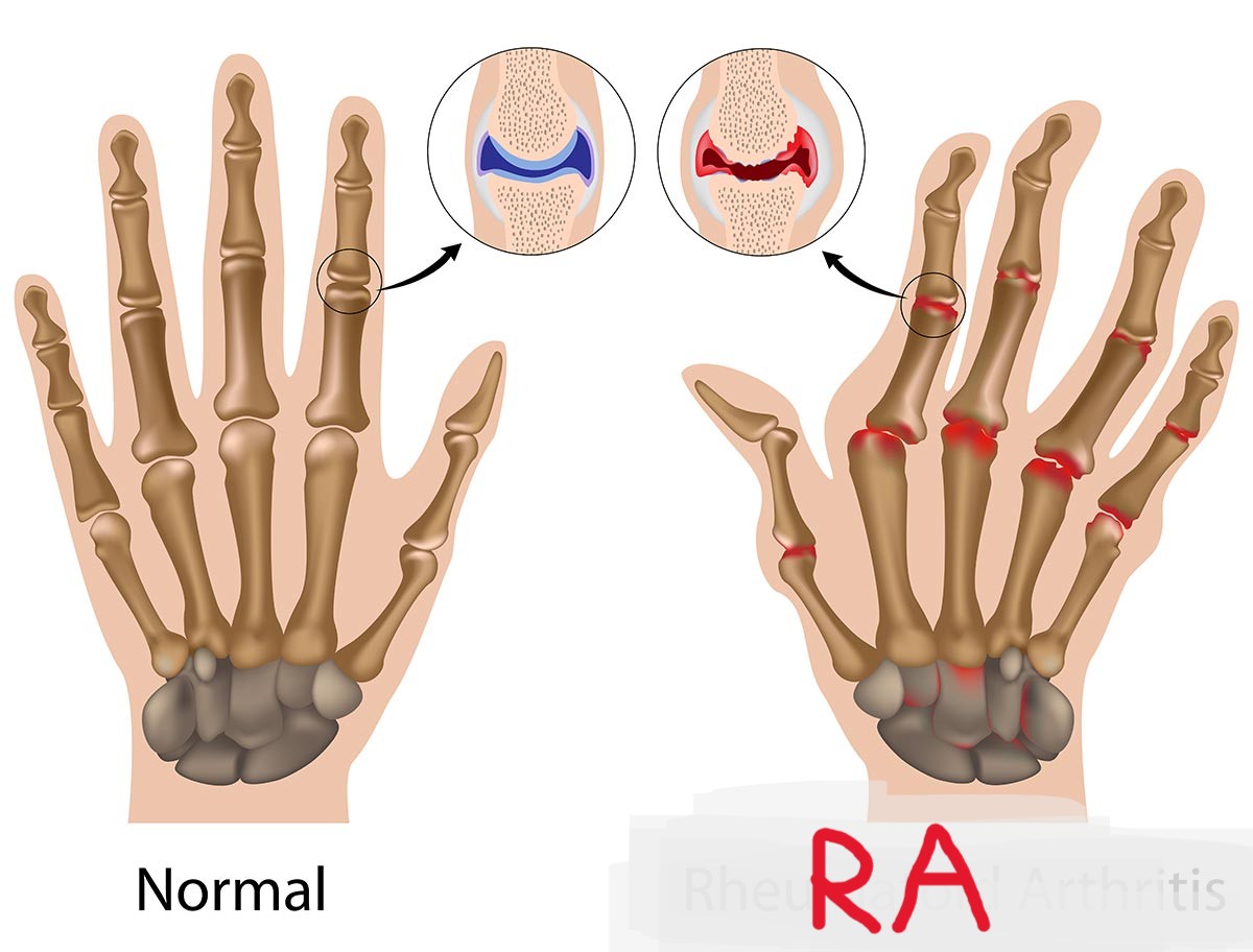 <p><strong>RA</strong></p>