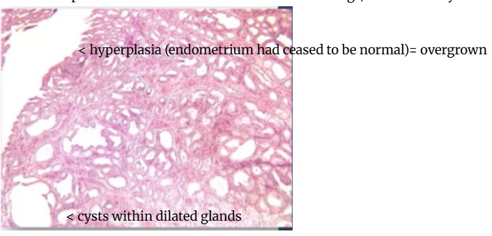 <p>cystic endometrial hyperplasia </p><p></p>