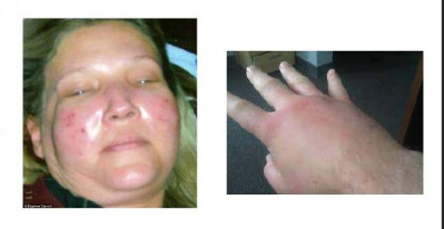 <ol><li><p>massive <span style="color: rgb(181, 132, 34);"><strong>edema </strong></span></p></li><li><p><span data-name="arrow_down" data-type="emoji">⬇</span><strong> </strong><span style="color: rgb(190, 100, 241);"><strong>perfusion</strong> → organ failure</span>!!</p></li><li><p><span style="color: rgb(226, 94, 94);"><strong>fluids shifts</strong></span> out of vessels</p></li></ol><p></p>