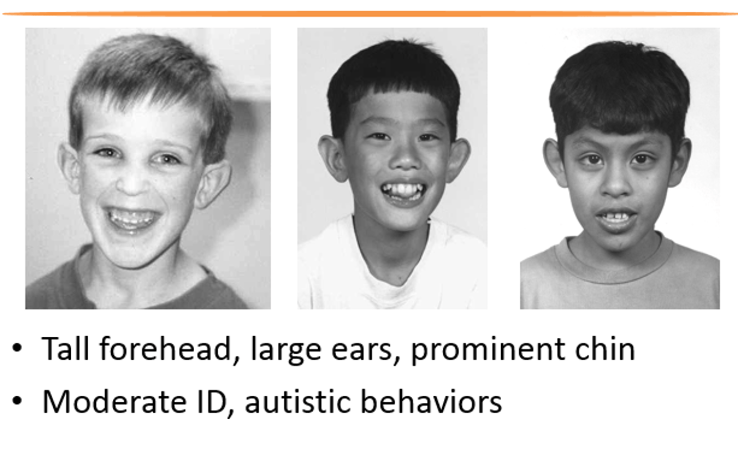 <p>- Its characteristics: Minor-to-severe intellectual disability, more severe in males; delayed speech and motor development, hyperactivity; the most common inherited form of intellectual disability</p><p>- Its incidence: 1 in 1,200 male births; 1 in 2,000 female births</p><p>- Its treatment Educational and behavioral therapies when needed</p>