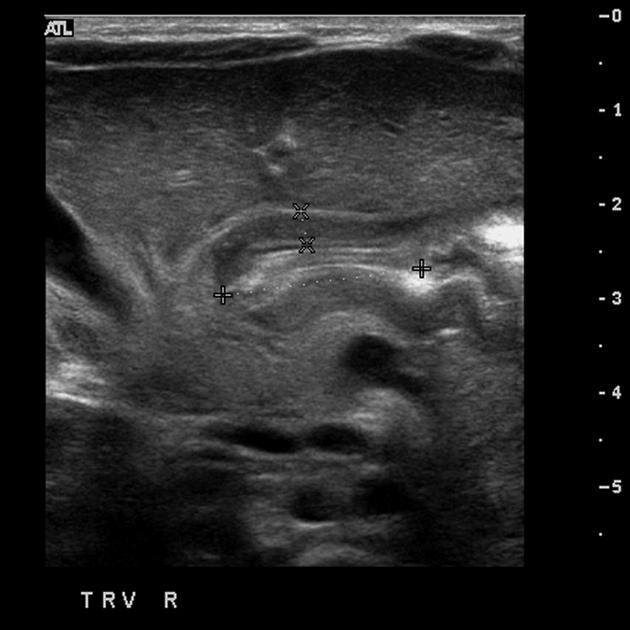 <p>Narrowing of the pyloric canal</p><p>Symptoms: Projectile vomiting, no weight gain and sever abdominal pain</p>