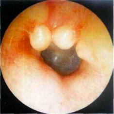 <p>Osteoma</p>