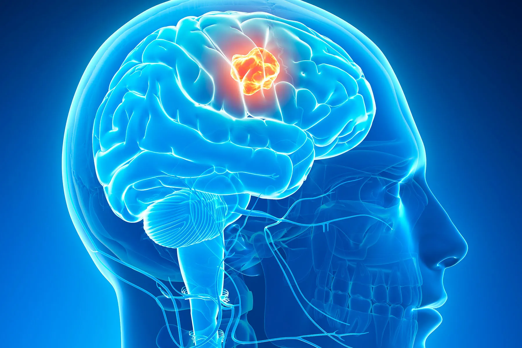 <p>Brain cancer is when bad cells grow in the brain and stop it from working well.</p><p>Example: A person may forget things or have trouble moving.</p>