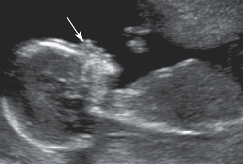 <p>15. What abnormality is noted in Figure 23-36?</p><p>Figure 23-36</p><p>a. Increased nuchal fold</p><p>b. Increased NT</p><p>c. Enlarged chest</p><p>d. Absent nasal bone</p>