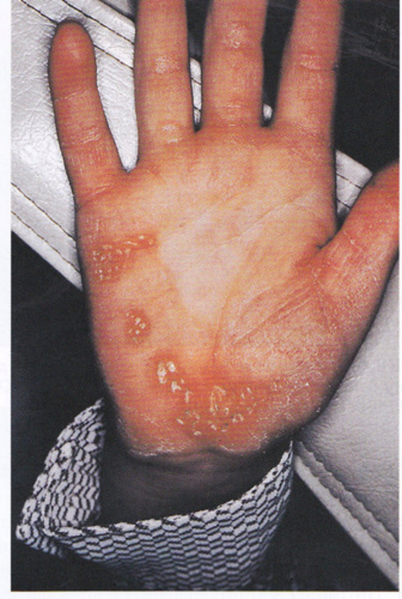<p><br>-lesion of the hand remain reddish white scaly, thick areas of hyperkeratinization</p><p>-autosomal-recessive inheritance</p>