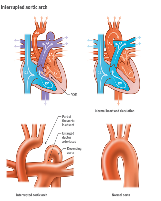 <p><strong>VSD (nonrestrictive)</strong></p><ul><li><p>most common in concordant ventriculo arterial connections</p></li></ul><p>ductus arteriosus</p><ul><li><p>most common in concordant ventriculo arterial connection</p></li></ul><p>truncus arteriosus</p>