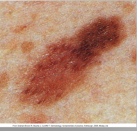 <p>atypical or dysplastic nevus are<strong> atypical moles</strong></p><p>irregular boarders, various shades of color, some ABCDE characteristics but less pronounced</p><p>increased risk of developing melanoma </p>