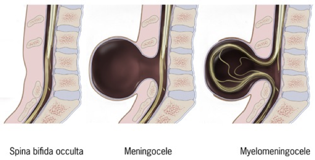 <ul><li><p>incomplete closure of the posterior (caudal/inferior ) neuropore</p></li><li><p>can happen anywhere on the spine </p></li><li><p>ranges from mild to severe(spina bifida occulta, meningocele, or myelomeningocele)</p></li><li><p>when the neural tube does not close all of the way, the backbone is uable to fully develop to protect the spinal cord</p></li><li><p>this can cause damage to the spinal cord and nerves</p></li></ul><p></p>