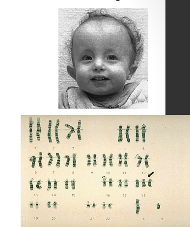 <p><strong>trisomy 18</strong></p><p>only 10% survive past one year</p><p>all <strong>die </strong>early in <strong>infancy </strong>with many complications</p>