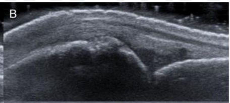 <p>Grade this synovial hypertrophy</p>