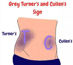 <p>Grey Turner sign </p>
