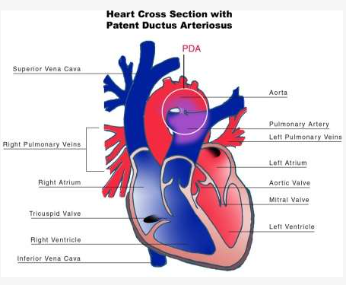 <p>De ductus botalli is een buisvormige structuur tussen de aorta en longslagader die bij de foetale circulatie een belangrijke functie heeft. Normaal zou deze in de eerste week na de geboorte moeten sluiten. Als dit niet gebeurd is er een continue links-rechtsshunt met een toename van de longflow als gevolg met daarbij een volumebelasting van het linker ventrikel. Er is dus overvulling van de longen, volumebelasting van het linkerhart en het hart moet extra pompen. Een grote open ductus kan klachten veroorzaken:</p><p>-Groeivertraging</p><p>-Verminderd uithoudingsvermogen</p><p>-Verhoogde vatbaarheid luchtweginfecties</p><p>-Decompensatio cordis </p><p>-Continue hartgeruis</p><p>-Heffende perifere pulsaties bij zuigelingen → normaal kan je de pulsaties van arteriën bij zuigelingen amper voelen </p><p>-Op lange termijn pulmonale hypertensie</p><p>Dit komt vooral voor bij premature baby’s (prostaglandines). Als er na 3 maanden geen spontaan herstel is wordt er gesproken van een aangeboren hartafwijking. Diagnose wordt gesteld met een kleurendoppleronderzoek.</p>