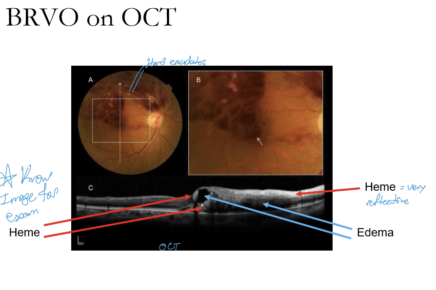 <p>Heme is hyperreflective with pockets of edema </p>