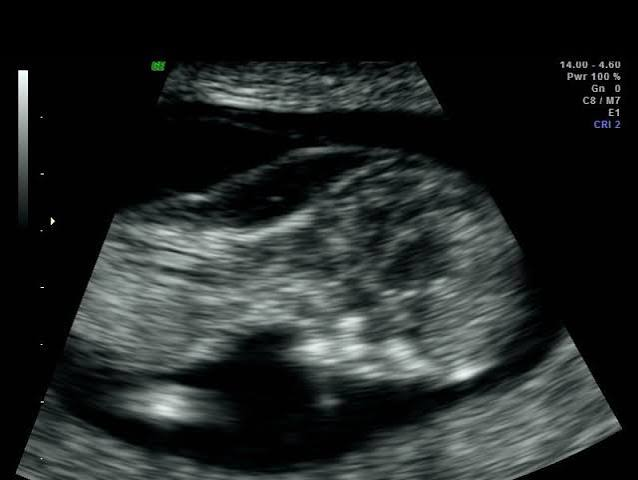<p>developmental defect of lymphatic system </p><ul><li><p>multiocular anechoic cervical mass </p></li><li><p>no cranial defect</p></li></ul><p></p>