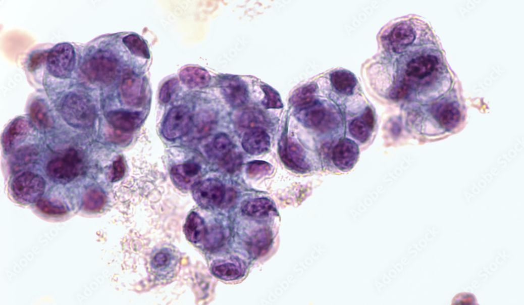 <p>Grandes cellules glandulaires atypiques avec nucléoles proéminents ± diathèse tumorale.</p><p>1) diagnostic principal</p><p>2) dd pertinents</p><p>3) clés d’exclusion</p><p>4) conduite</p>
