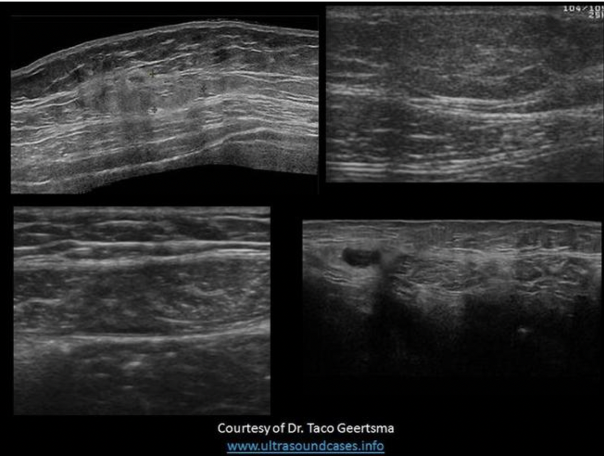 <p>Find the lipoma</p>