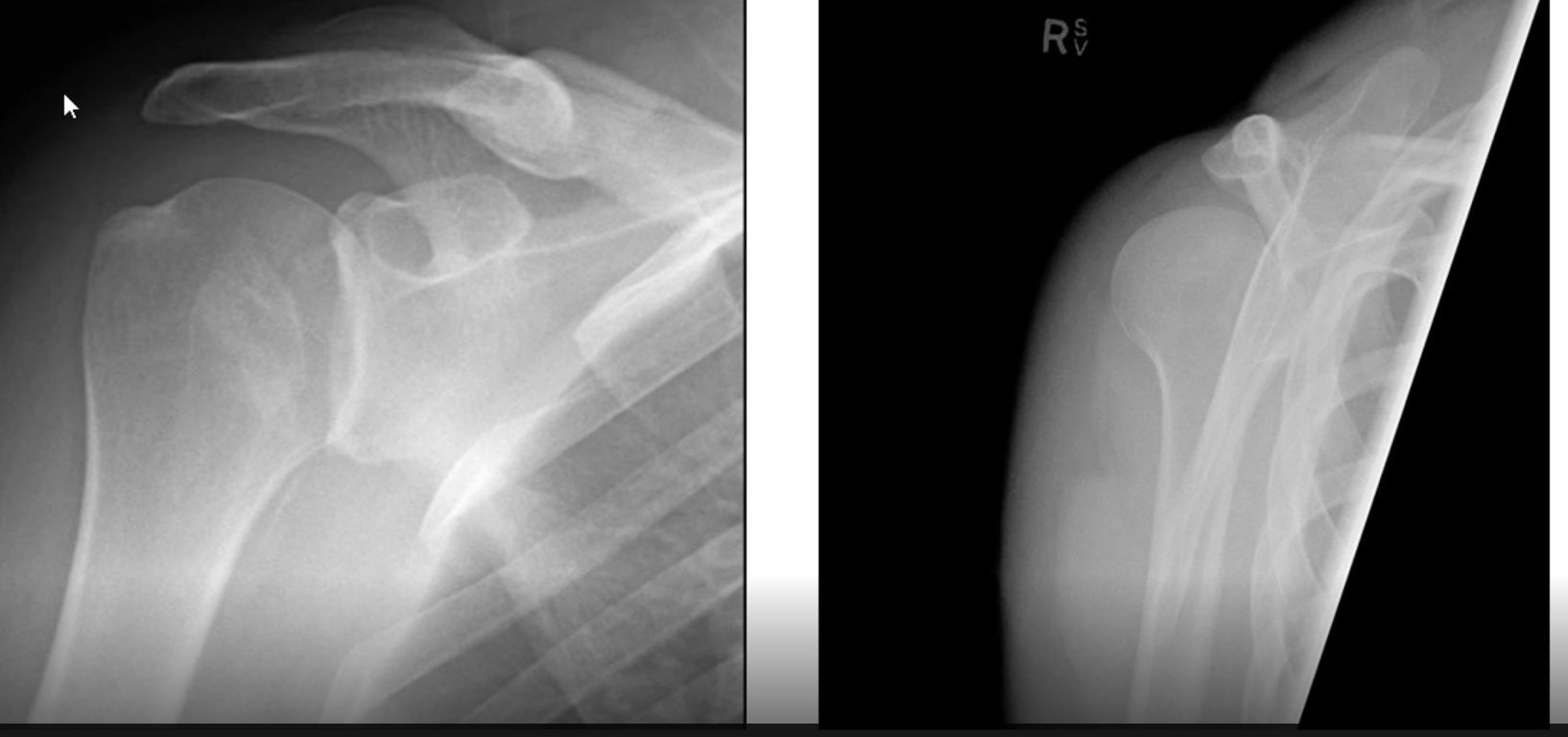 <ul><li><p><span>Less common, overuse injury</span></p></li><li><p><span>On exam: adduction and internal rotation (sling position)</span></p></li><li><p><span>Humeral head behind glenoid fossa</span></p></li></ul><p></p><p></p>