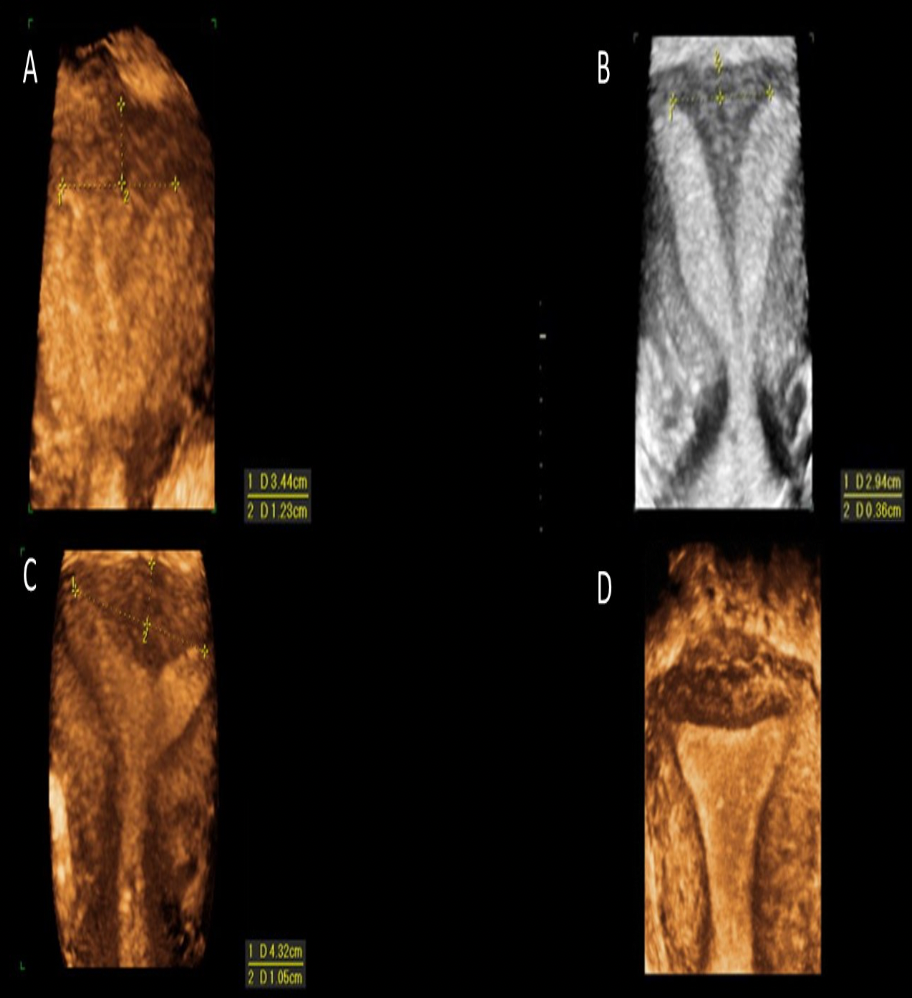 <p>Which of the images demonstrates an arcuate uterus?</p><p>A</p><p>B</p><p>C</p><p>D</p>