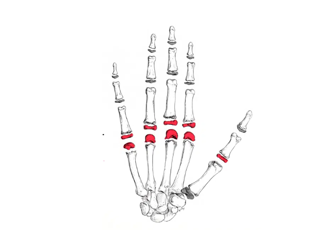 <p>Joints between the heads of metacarpals and bases of proximal phalanges.</p>