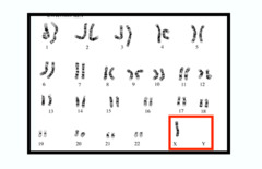 <p>- Females with only 1 X chromosome (due to monosomy)</p>
