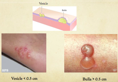 <p>A small, elevated lesion less than 1 cm that contains serous fluid.</p>